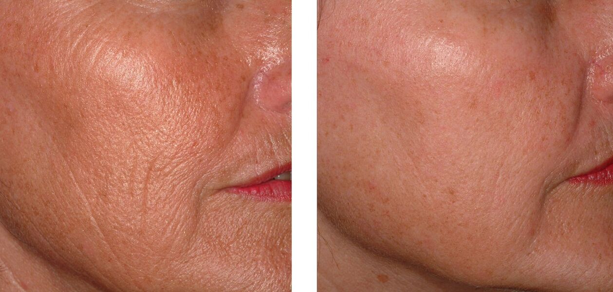 Skin rejuvenation