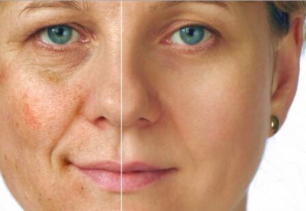 The result of rejuvenation