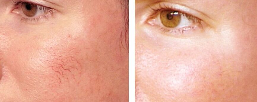Removal of rosacea