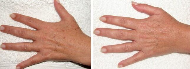 Result of removing pigment spots on the hands