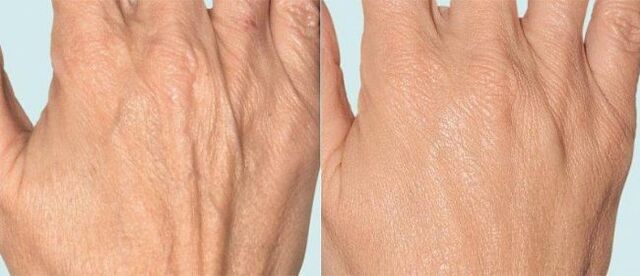 Skin of the hands before and after fractional therapy