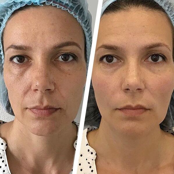 face photos before and after laser rejuvenation